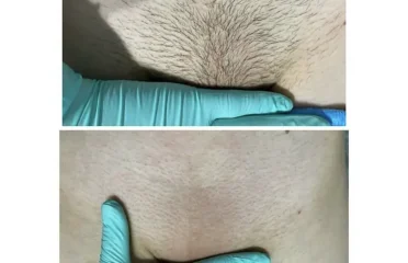 Помочь с эпиляцией воском и сахаром